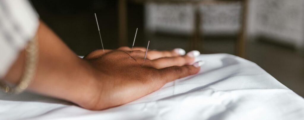 Close-up of acupuncture needles in a hand during treatment, promoting relaxation.