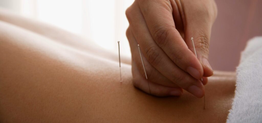 A close-up image showing a hand placing acupuncture needles into a person's back, with a soft focus on the background. This treatment is a component of alternative therapies that can be explored under Friday Health.