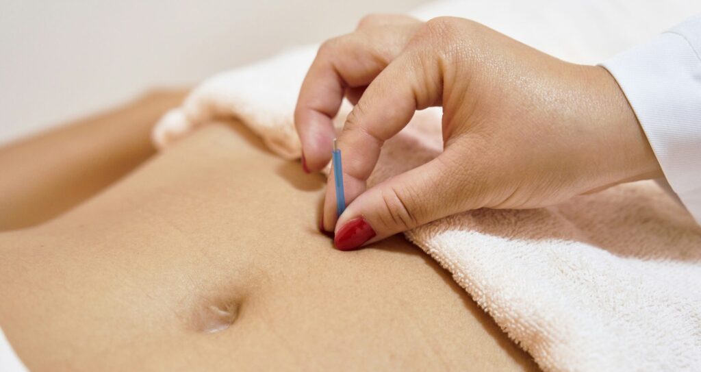 A hand is seen placing a small acupuncture needle on the abdomen of a person, who is lying down covered with a towel. The image relates to Friday Health and represents alternative health practices.